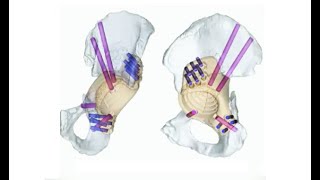 Custom Triflanged Acetabular Reconstruction