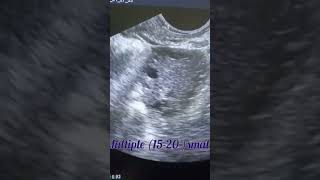 pcos tvs scan finding