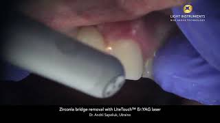 Zirconia bridge removal with LiteTouch™ Er:YAG laser