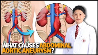 What is Abdominal Aortic Aneurysm? What causes the disease? How can we treat it?