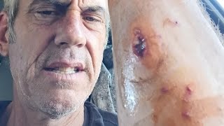 MRSA? STAPH? WATCH THIS!!! CRAIG LEWIS STEVENS / TAPLEY REMEDY FROM THE HIGHEST POWER