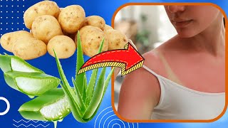 Sunburn – Top 7 Natural Cures for Sunburn