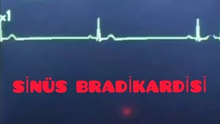 SİNÜS BRADİKARDİSİ