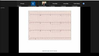 Atypical AVNRT   Dr  Ahmed Nabil