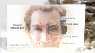 curar sinusitis cronica