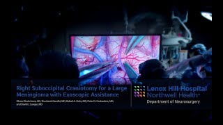 Right Suboccipital Craniotomy for a Large Meningioma with Exoscopic Assistance