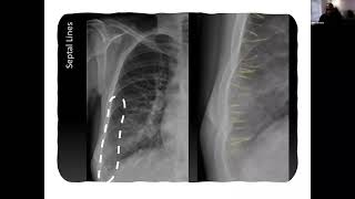 Approaches to Chest Radiograph Interpretation (Part 2)