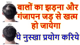 गंजेपन का आयुर्वेदिक उपचार | नये बाल उगाने का उपाय | बाल उगाने का इलाज | बाल झड़ने के कारण व उपाय