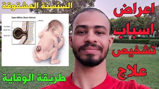 السنسنة المشقوقة (اسباب، اعراض، تشخيص، علاج) Spina bifida