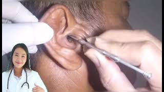 Dr.Nattacha, satisfying video earwax removal, earcleaning.