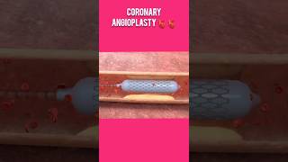 Angioplasty 🫀💥 #shorts #viral #satisfying #respect #trending #medical