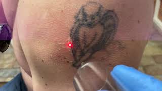 Laser tattoo removal black Angel tattoo on shoulder of a male