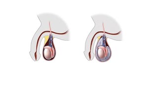अंडकोष की सूजन या अंडकोष में पानी भर जाना घरेलू उपाय अपनाएं