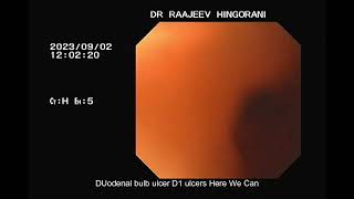 Duodenal (Peptic) ULCER #gastronautclinic #patient #health #gastro #ulcer #treatment #endoscopy #yt