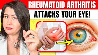 The Shocking Link Between Rheumatoid Arthritis and Eye Health