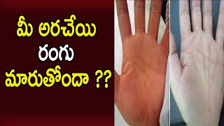 మీ అరచేయి రంగు మారుతుందా? | What Do Your Hands Color Say?