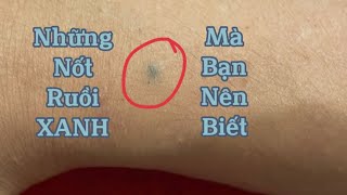 Những nốt ruồi Xanh đặc biệt trên cơ thể mà bạn nên cần phải quan tâm