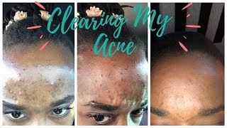 Why My Acne Pissed Me Off & How I Fixed It | GatHouse Fitness [147]