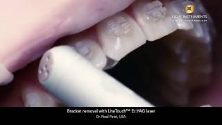 Bracket removal with LiteTouch™ Er:YAG laser