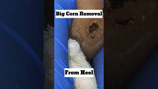 Big foot corn removal@DrArifMDDermatologist #corn #skin