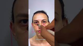 Caso transformador de harmonização facial pelo Dr Murilo Cecilio.