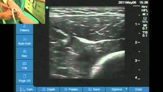 Ultrasound location of radial nerve at elbow