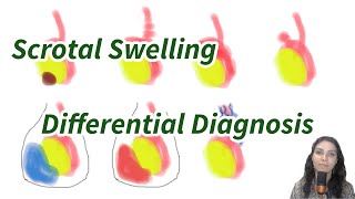 Scrotal swelling and Undescended testis (UDT)