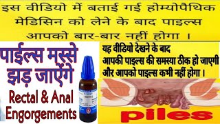 Best Piles Homoeopathic Medicine//Negundium Americana Q//PILES Warts  Most Effective Medicine//HM4U.