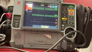 Synchronized Cardioversion