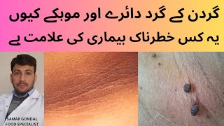 reason for circular blackish ring around neck & skin tags | insulin resistance