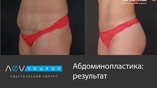 Результаты абдоминопластики | Лев Соцкий