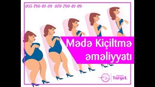 Mədə kiçiltmə əməliyyatı Phd Op.Dr Taryel Ömərov