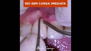 RDI Sem Carga Imediata #shorts