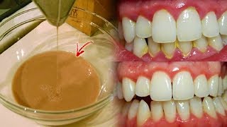 Remove Plaque OVERNIGHT 😁 | 😁 This Mouthwash Removes Plaque From Teeth OVERNIGHT!