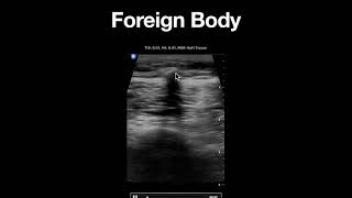 Soft Tissue Foreign Bodies