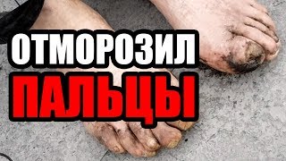 ЛюдиУблюди (Серия 50). Бомж отморозил ноги. Ампутация / Гангрена. Слоновая болезнь. Савеловская.