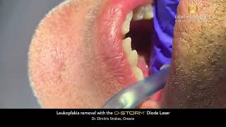 Leukoplakia removal with the D-Storm™ Diode Laser