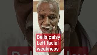 "Bell's Palsy Explained: Symptoms, Treatments, and Real-Life Stories"