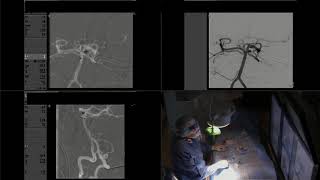 Endovascular Coil Embolization of Ruptured Small Aneurysm of the Posterior Circulation