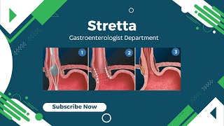 Stretta Treatment - [#1 Hospital with Best Doctors in Dubai]