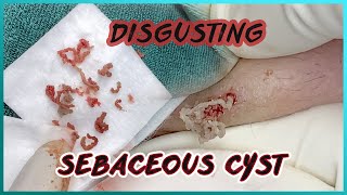 Big Cystic Acne Blackheads Extraction Blackheads & Milia, Whiteheads Removal Pimple Popping