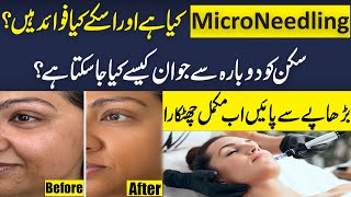 What Is Micro needling? | Benefits Of Micro Needling | Chehre Ky Daag Dhabon Sy Mukamal Chutkara