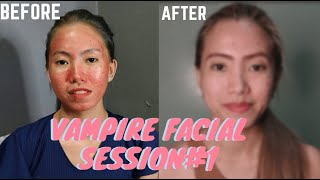 1ST SESSION RESULT| Vampire Facial SCAR Treatment at Prettydose Davao