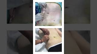 Dr. Alejandro Acuña | Vaser Lipo Abdomen