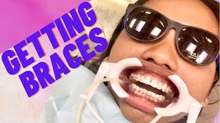 GETTING BRACES IN TORONTO 😬#braces