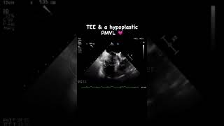 Transesophageal echo & a hypoplastic posterior mitral valve leaflet 🤩