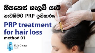 PRP Treatment for hair loss / හිසකෙස් යෑම සඳහා සිදු කරන 𝐏𝐑𝐏 ප්‍රතිකාරය