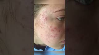 pharmacy cream for all problems on skin #azedermcream #pigmentationremovalcream #acne #viral #trend