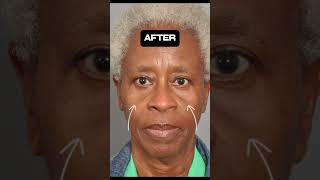 Lower Blepharoplasty- Dr. Perenack