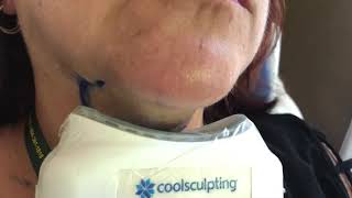 Double chin removal with CoolSculpting at Excellase in Raleigh